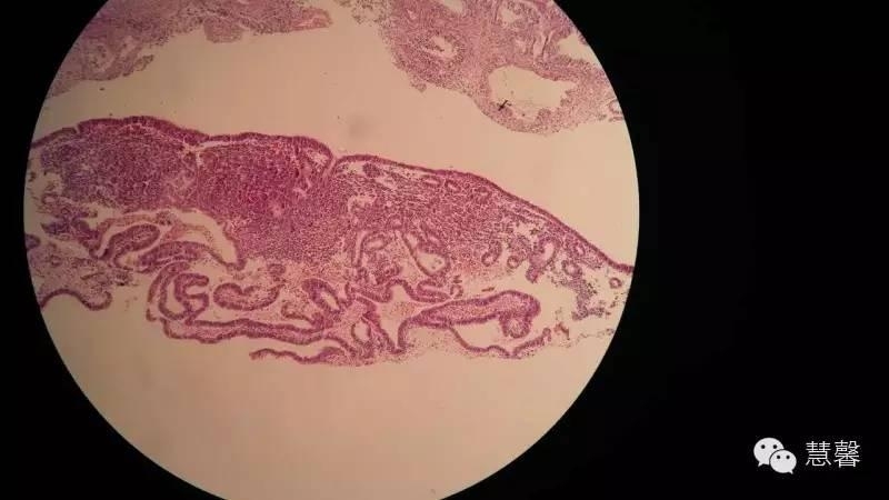 他莫昔芬相关性子宫内膜息肉（李慧娜分享，刘从容老师讲解）