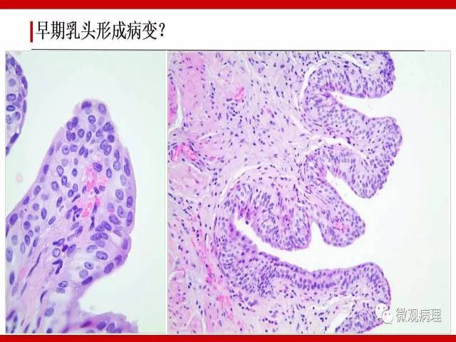 膀胱尿路上皮肿瘤诊断的一些困惑