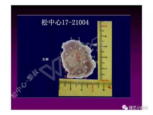 上消化道早癌病理的学习心得体会（附胃牵手癌的病例特点文献学习）