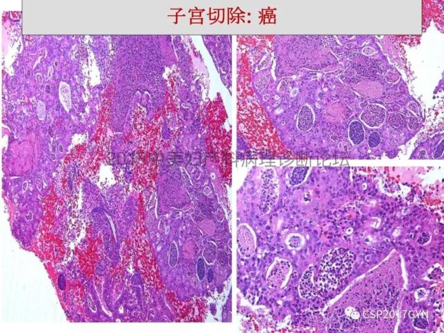 子宫内膜假肿瘤性病变及类似癌样病变