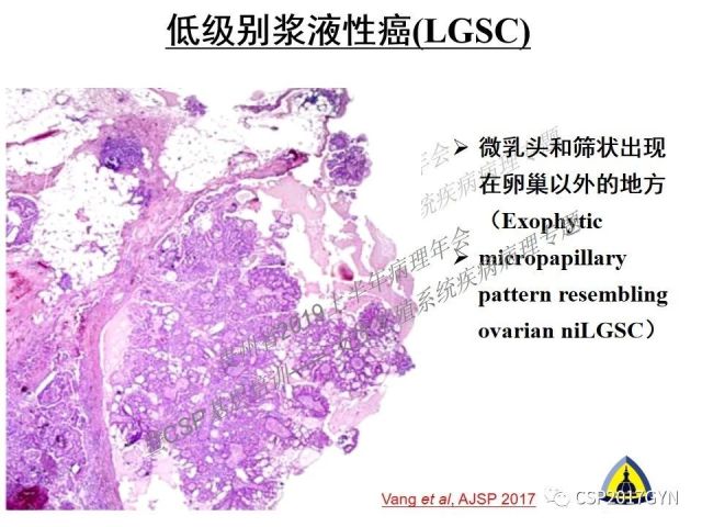 中华病理学会基层培训遵义站讲座（一）——卵巢和输卵管浆液性肿瘤的诊断和鉴别诊断