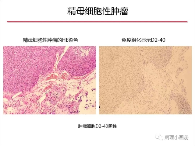 泌尿病理--精原细胞瘤VS精母细胞瘤