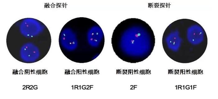 染色体异常FISH检测——淋巴瘤分子病理常规诊断工具