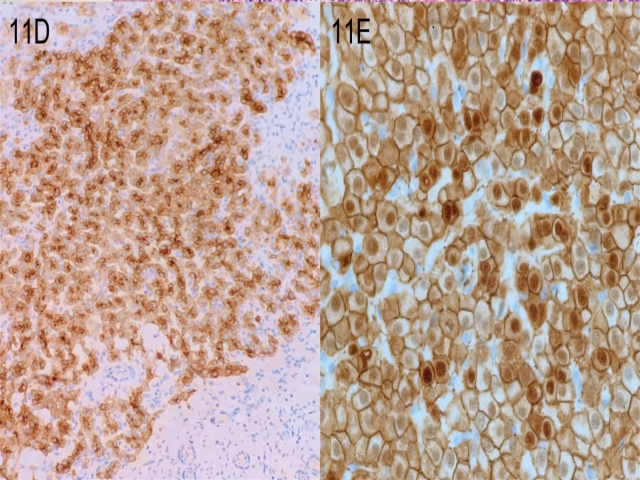 家族性腺瘤性息肉病综合征之庖丁解牛（五）