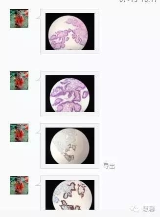 宫颈腺体原位癌及绒毛状管状腺癌的问题（未雨分享，刘从容老师讲解）