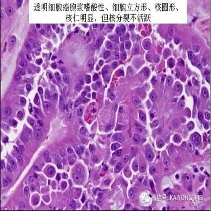 卵巢癌的病理诊断新进展（三）