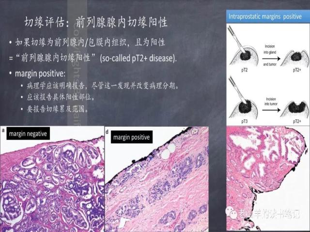 AJCC第8版 前列腺癌分期 之 病理学要点