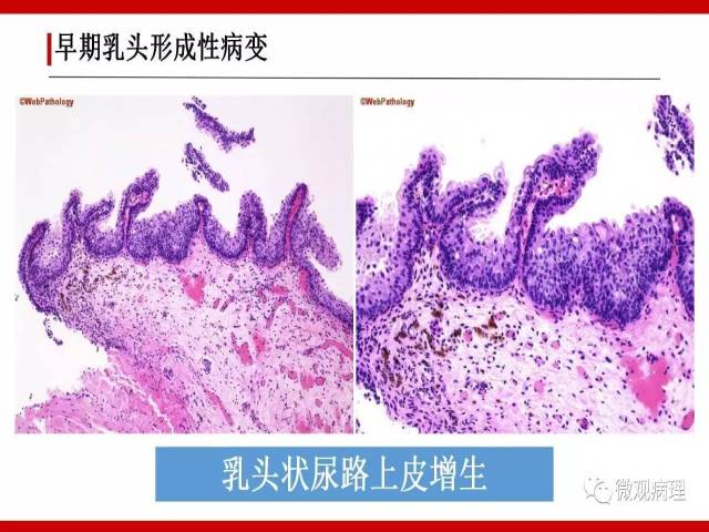 泌尿课程/尿路上皮病变的基本生长方式