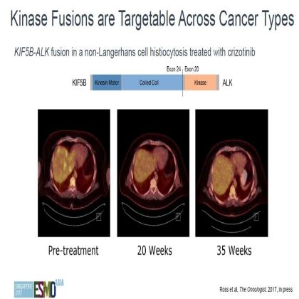 Genomic profiling of 114,200 advanced cancers identifies recurrent kinase domain duplications (KDD)