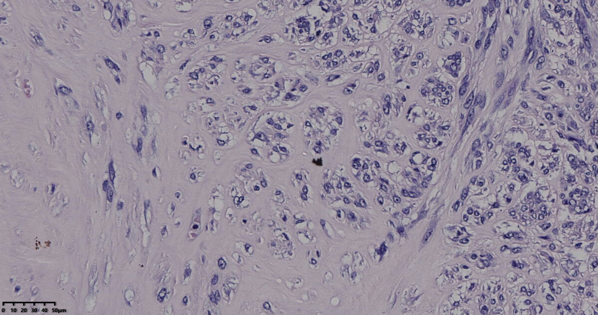 子宫多发性平滑肌瘤伴肉瘤