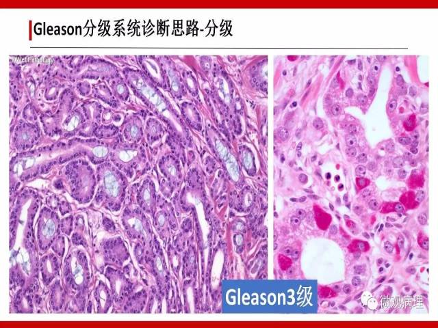 前列腺癌Gleason分级系统的前世今生