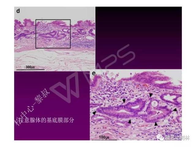 上消化道早癌病理的学习心得体会（附胃牵手癌的病例特点文献学习）