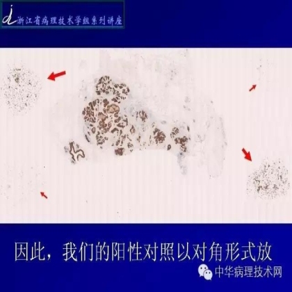 《常规免疫组化初筛ALK阳性非小细胞肺癌专家共识》技术部分解读