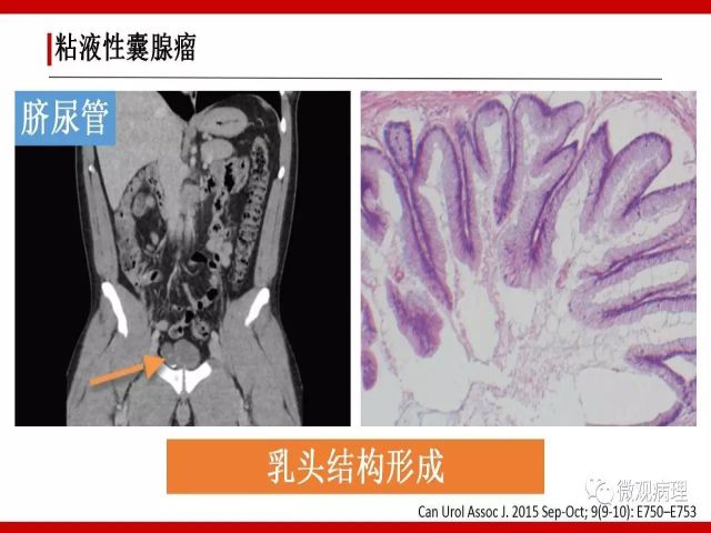 泌尿课程/尿路腺样病变的诊断要点