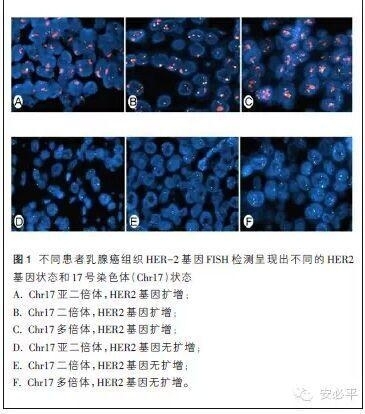 乳腺癌患者17号染色体非整倍体的临床病理学意义