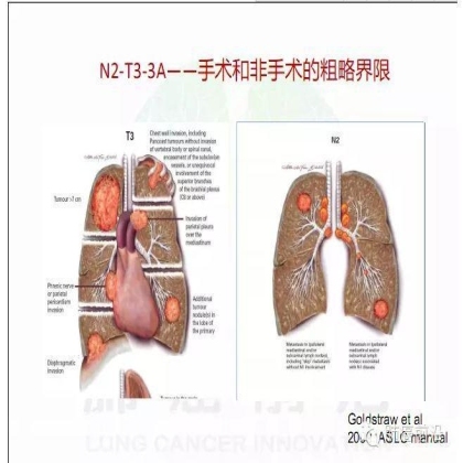 肺癌新分期和分类--临床和研究启示
