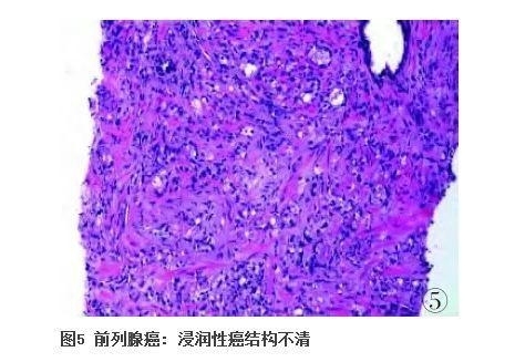 前列腺疾病的免疫组化诊断