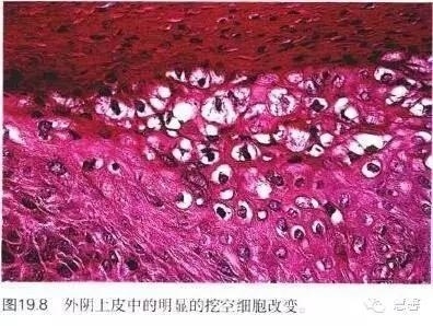 阴道鳞状上皮乳头状瘤？尖锐湿疣？（孔祥田老师病例分享，粉蓝医疗科技（杭州）有限公司女性生殖2群讨论，孔祥田(Max)*Roswell*老师讲解）