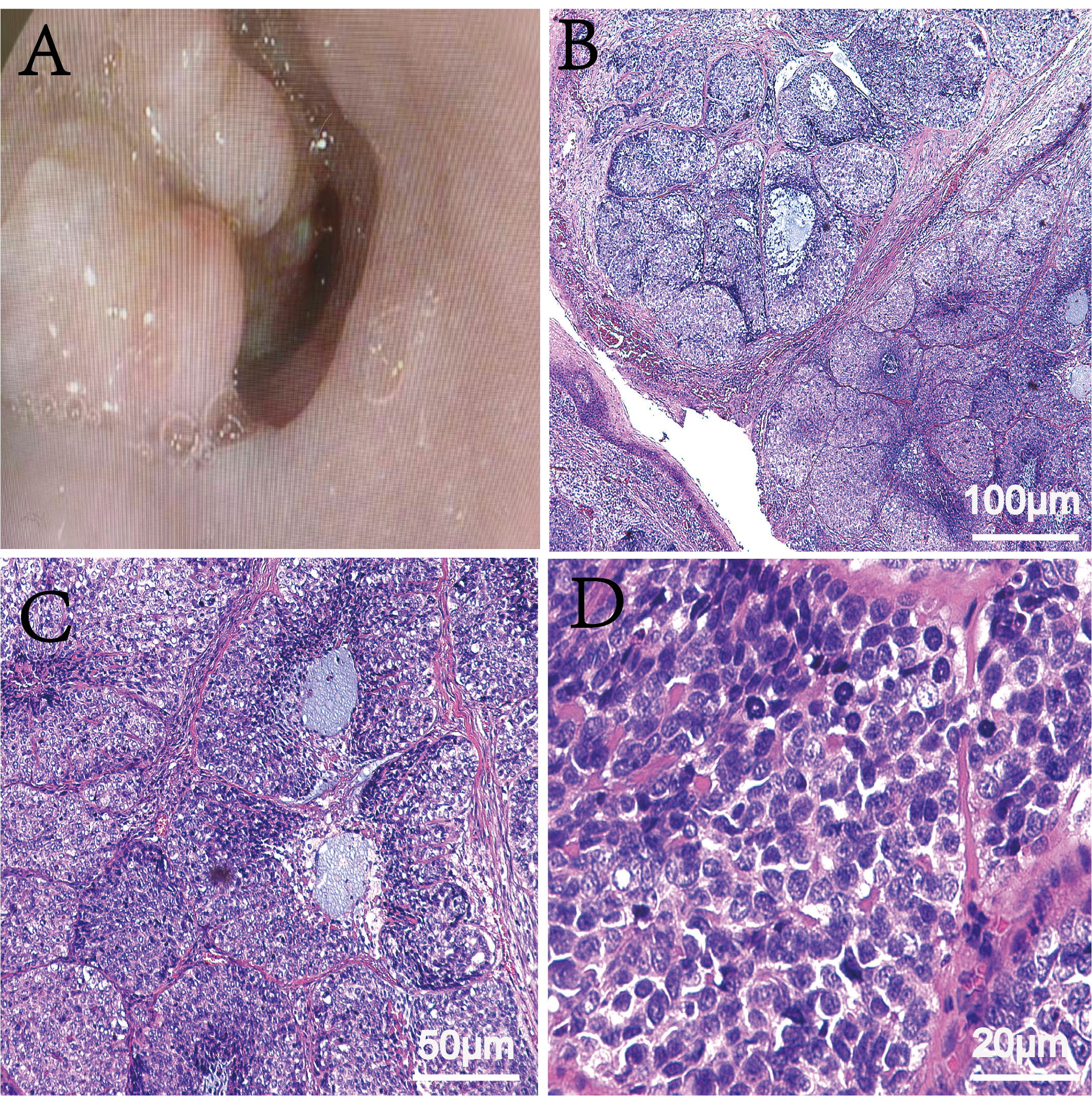 病例分享 | 食管基底样鳞状细胞癌1例