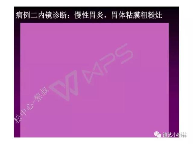 上消化道早癌病理的学习心得体会（附胃牵手癌的病例特点文献学习）