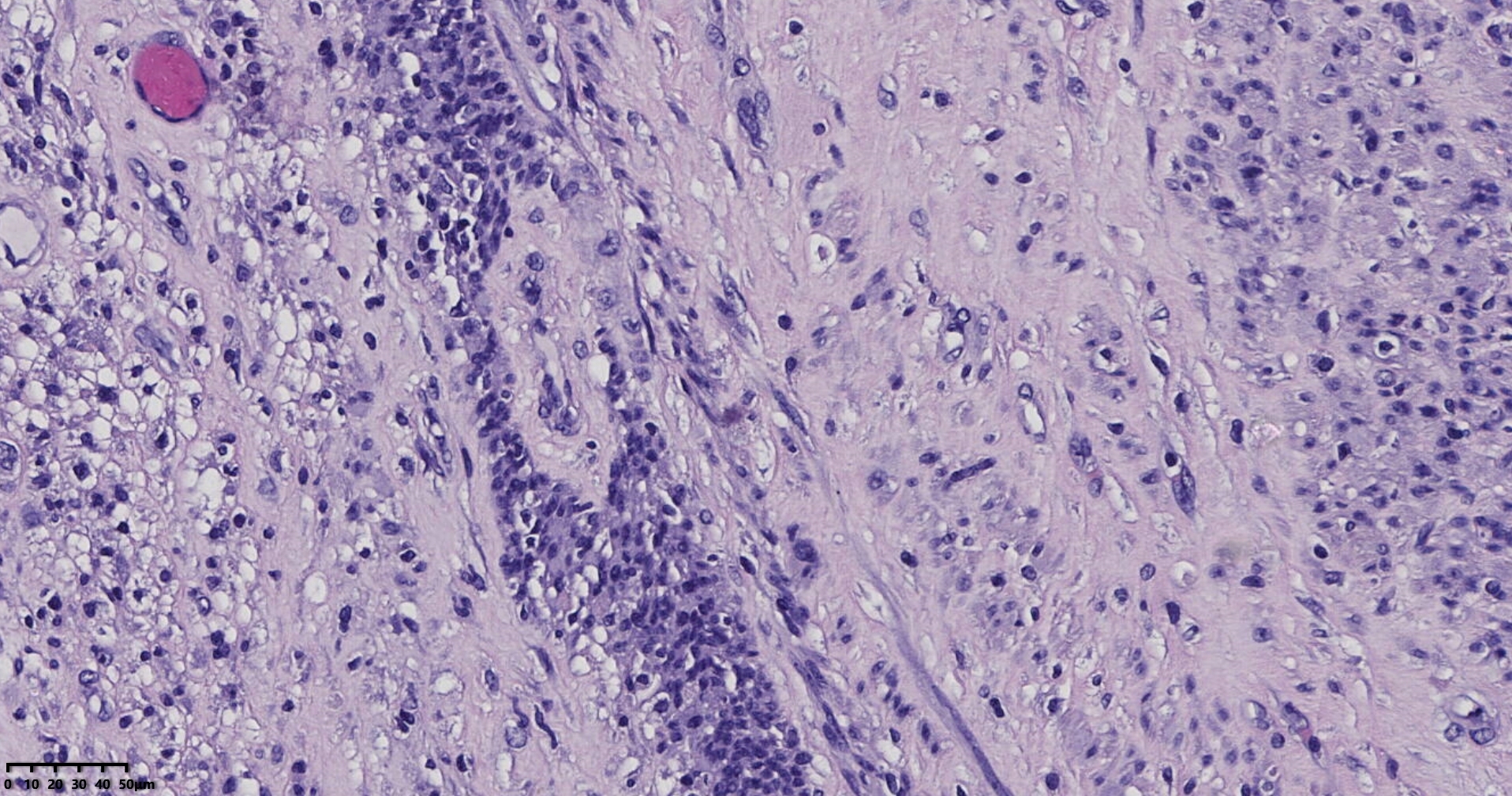 子宫多发性平滑肌瘤伴肉瘤