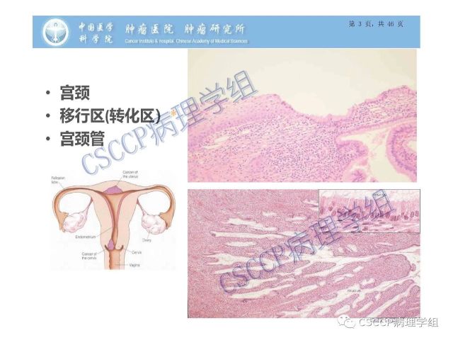 宫颈癌前病变中的诊断难点及阴道镜中ECC的 应用价值