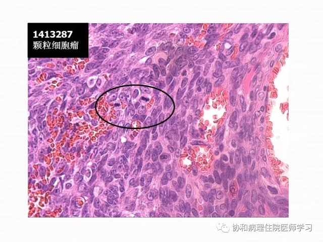 病理学基础知识 : 核分裂像的识别