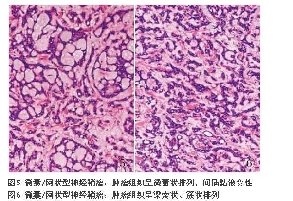 新近认识的胃肠道间叶性肿瘤