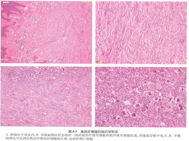 良性纤维组织细胞瘤