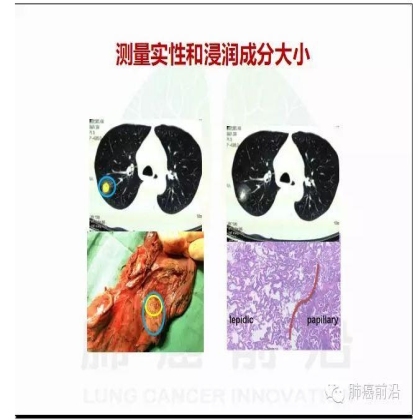 肺癌新分期和分类--临床和研究启示