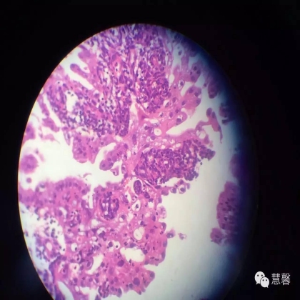 子宫内膜乳头状增生（甜甜分享病例，孔祥田(Max)*Roswell*老师讲解，kent翻译整理文献）