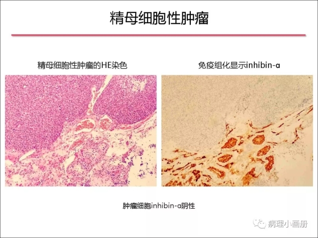 泌尿病理--精原细胞瘤VS精母细胞瘤