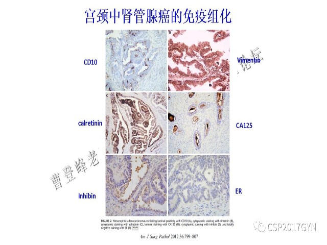 妇科肿瘤病理新进展——特殊类型的腺癌