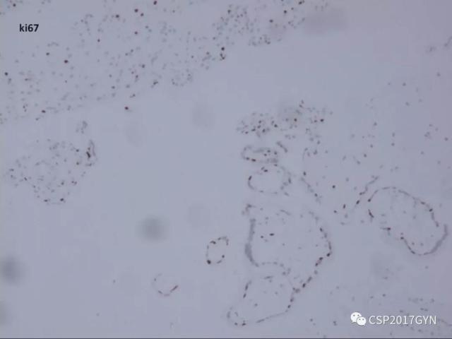 妊娠滋养细胞肿瘤的临床病理学进展