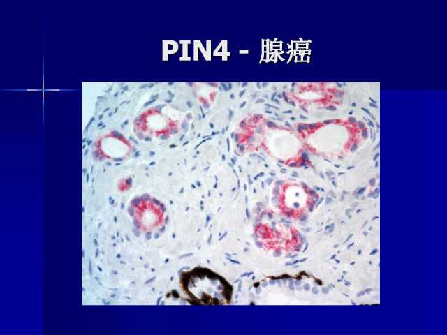 前列腺病理诊断线索（上）——黄教悌
