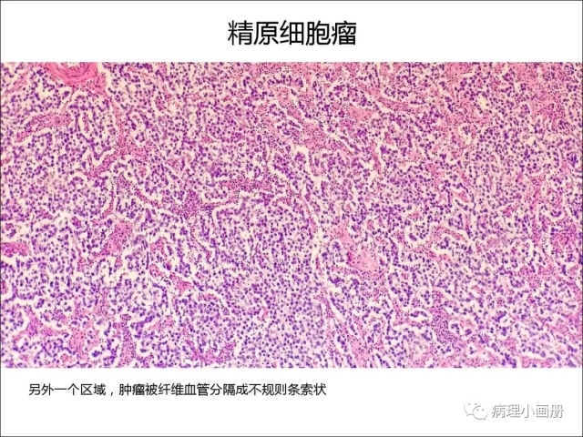泌尿病理--精原细胞瘤VS精母细胞瘤