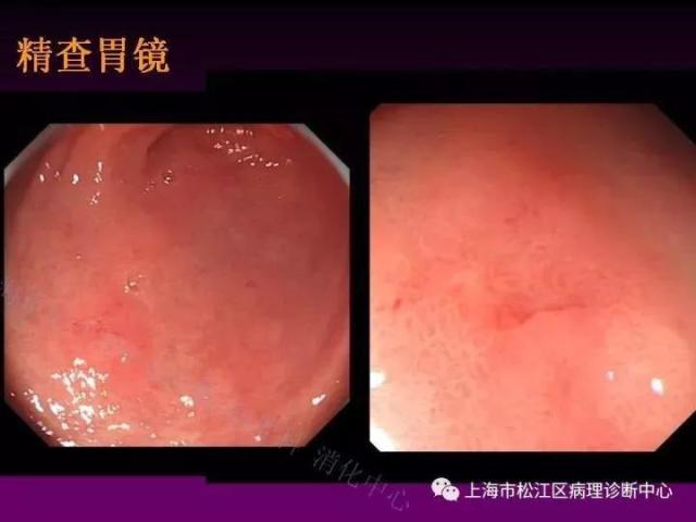 上消化道低级别上皮内瘤变的那些事