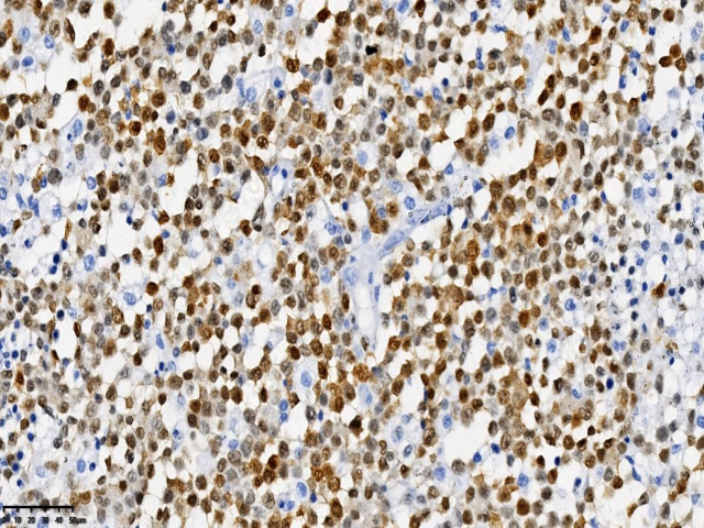 HIV相关性原发性中枢神经系统弥漫大B细胞淋巴瘤1例