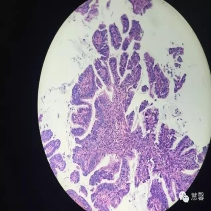 宫颈绒毛状腺癌诊断及相关问题（沈苗分享病例，刘从容老师讲解）