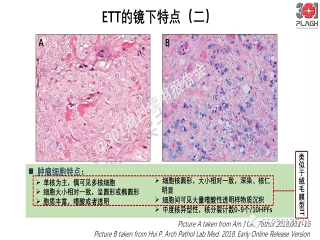中间型滋养细胞肿瘤的诊断及鉴别诊断