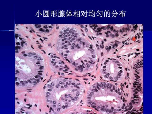 前列腺病理诊断线索（上）——黄教悌