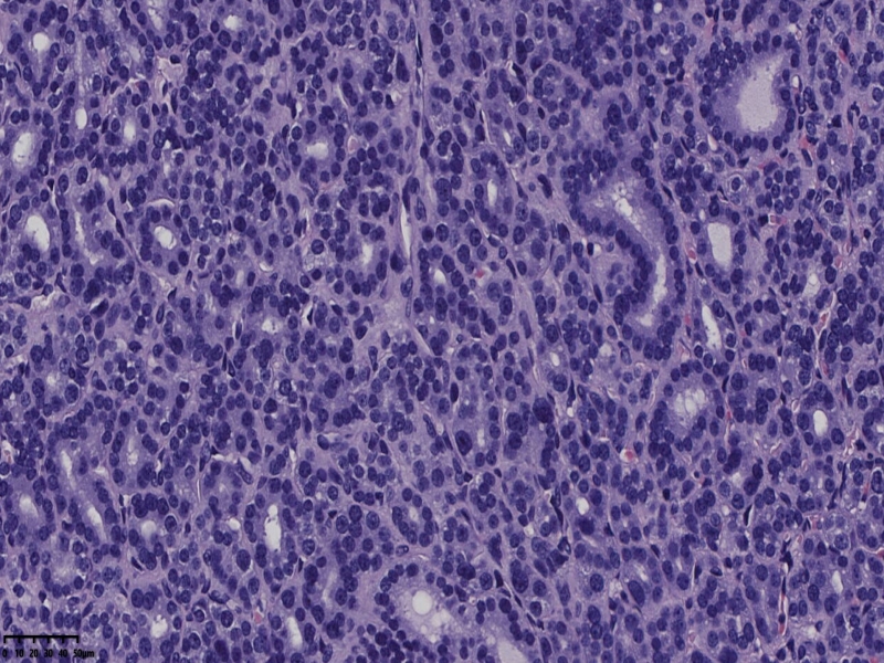 这个甲状腺肿瘤怎么看？