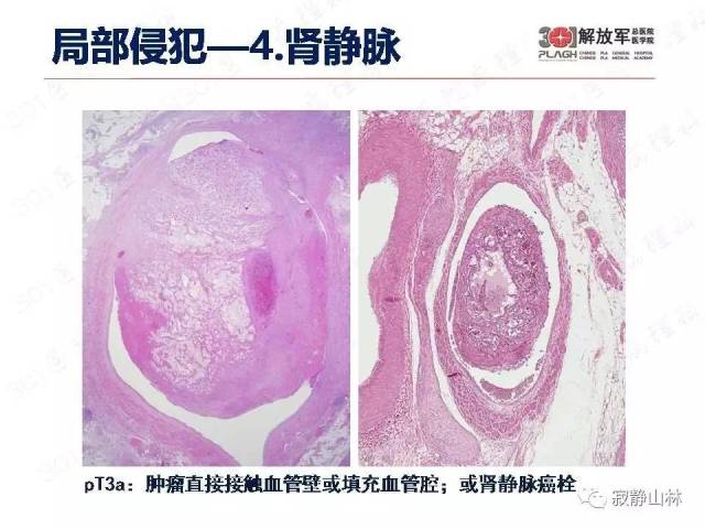 泌尿系统常见肿瘤标本病理报告规范