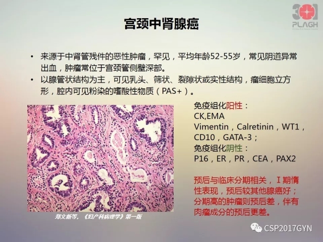 宫颈腺癌的临床病理研究进展