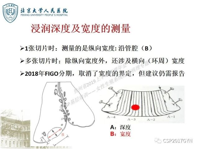 中华病理学会基层培训遵义站讲座（三）——宫颈鳞状上皮病变的病理诊断与鉴别诊断