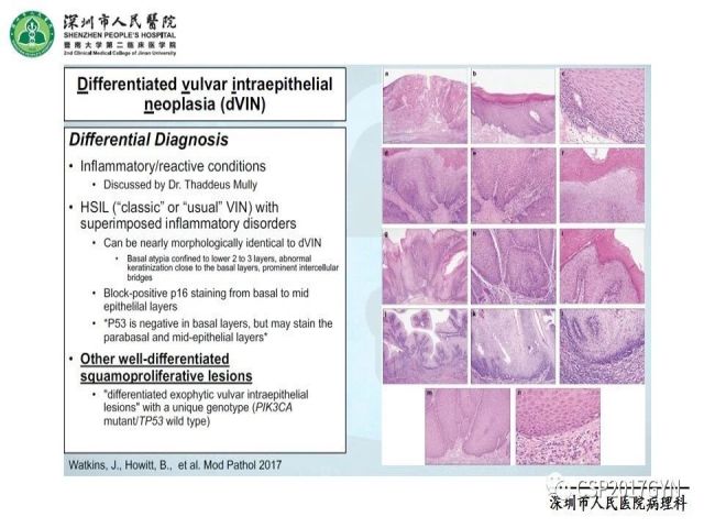 2019USCAP妇科病理热点介绍