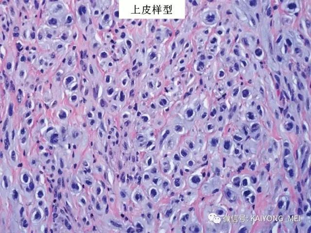 乳腺梭形细胞病变的病理诊断及进展（一）