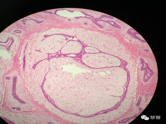 乳腺纤维腺瘤与叶状肿瘤的鉴别要点（李军红分享，孔祥田老师讲解）