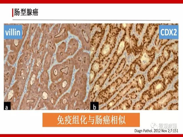 泌尿课程/尿路腺样病变的诊断要点