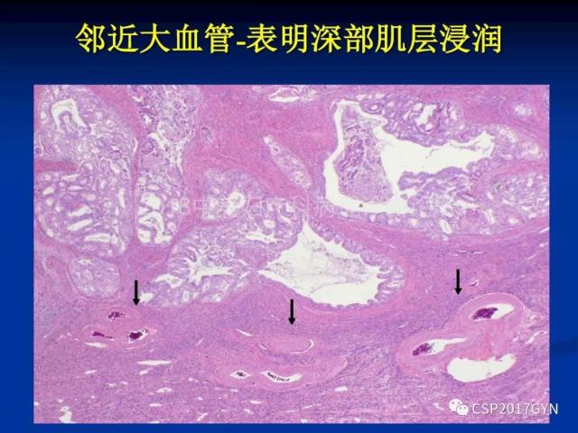 子宫内膜癌：诊断与进展
